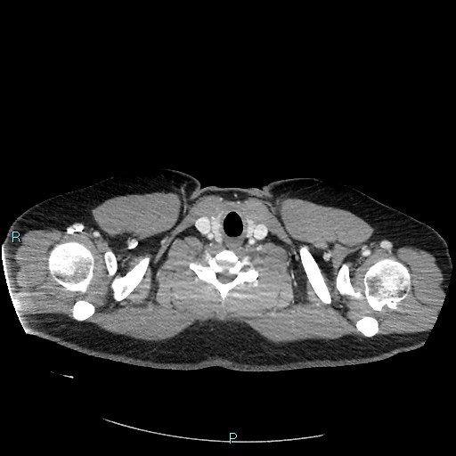 Bronchial carcinoid tumor (Radiopaedia 78272-90875 A 7).jpg