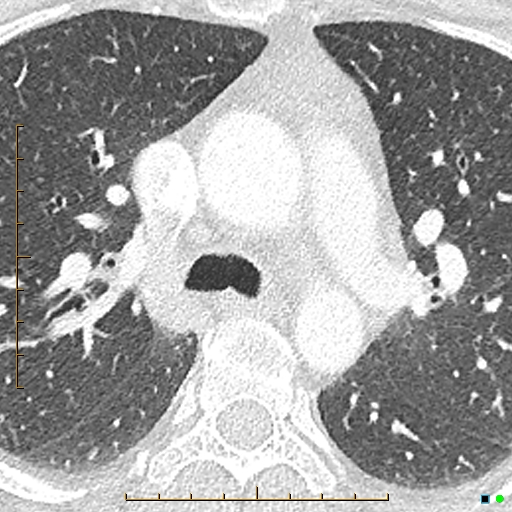 File:Bronchial diverticula (Radiopaedia 79512-92677 Axial lung window 3).jpg