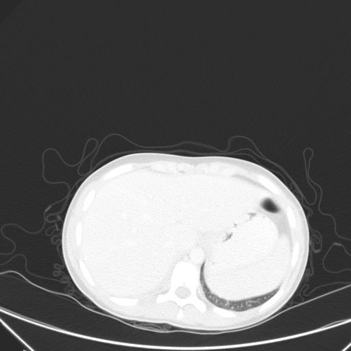 Bronchial mucoepidermoid carcinoma (Radiopaedia 57023-63895 Axial lung window 110).jpg