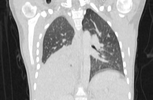 Bronchial mucoepidermoid carcinoma (Radiopaedia 57023-63895 Coronal lung window 40).jpg