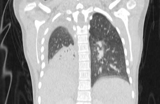 Bronchial mucoepidermoid carcinoma (Radiopaedia 57023-63895 Coronal lung window 62).jpg
