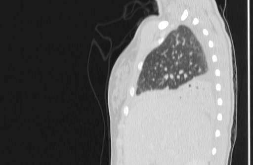 Bronchial mucoepidermoid carcinoma (Radiopaedia 57023-63895 Sagittal lung window 12).jpg