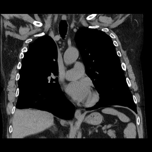 Bronchial stenosis - lung transplant (Radiopaedia 73133-83848 Coronal non-contrast 34).jpg