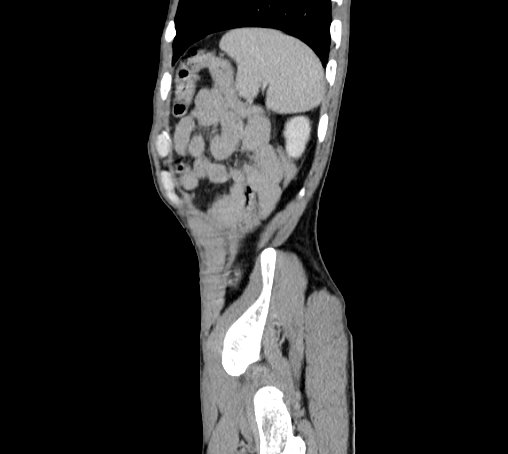 Bronchiectasis in Crohn disease (Radiopaedia 60311-67977 D 105).jpg