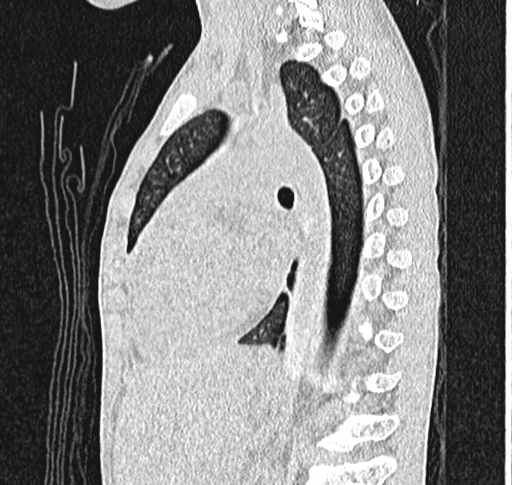 Bronchiolitis obliterans (Radiopaedia 71538-81897 Sagittal lung window 40).jpg