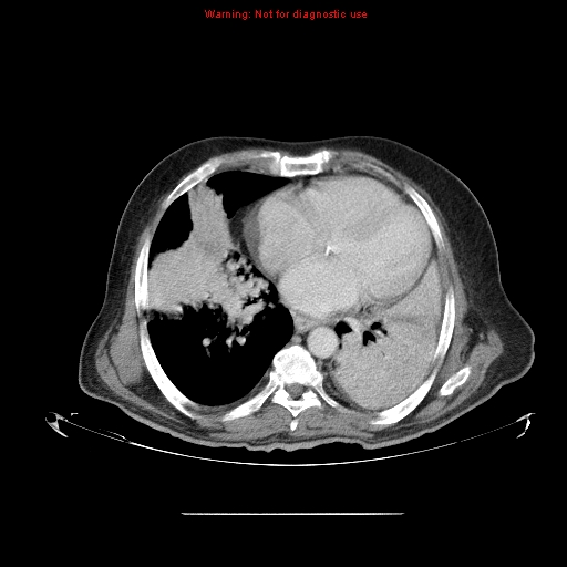 File:Bronchioloalveolar carcinoma (Radiopaedia 9272-9955 A 20).jpg