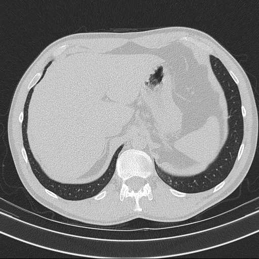 Bronchocele (Radiopaedia 60676-68429 Axial lung window 68).jpg