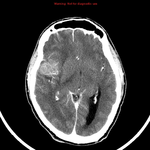 File:Bronchogenic carcinoma brain metastasis (Radiopaedia 9286-9970 B 13).jpg