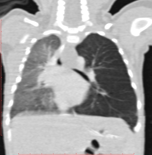 Bronchogenic cyst (Radiopaedia 78599-91409 Coronal lung window 129).jpg