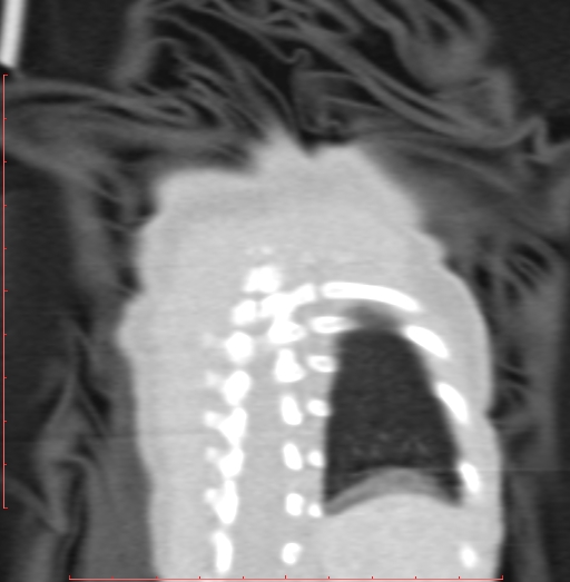 Bronchogenic cyst (Radiopaedia 78599-91409 Coronal lung window 206).jpg