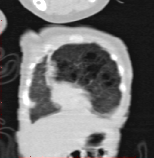 File:Bronchogenic cyst (Radiopaedia 78599-91409 Coronal lung window 37).jpg