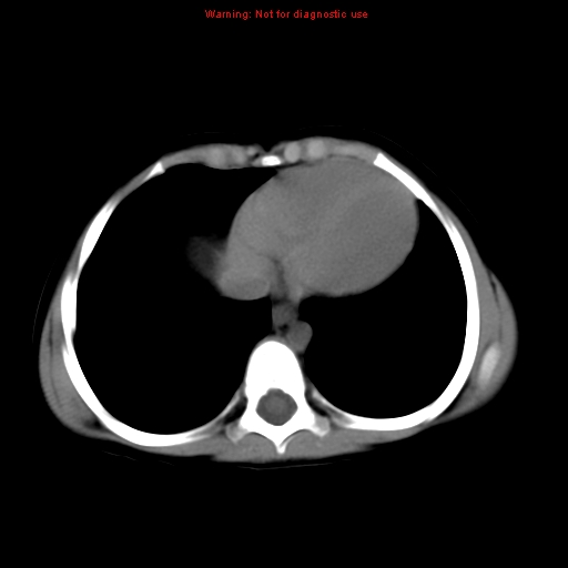 File:Bronchogenic cyst (Radiopaedia 9372-10063 Axial non-contrast 13).jpg