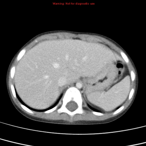 File:Bronchogenic cyst (Radiopaedia 9372-10063 C 24).jpg