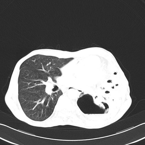 Bronchopleural fistula secondary to tuberculosis (Radiopaedia 20415-20322 Axial lung window 32).jpg