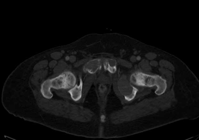 Brown tumors compressing the spinal cord (Radiopaedia 68442-77988 G 126).jpg