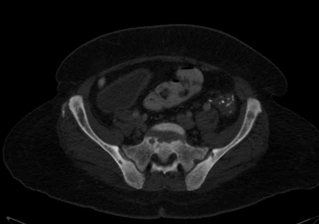 Brown tumors compressing the spinal cord (Radiopaedia 68442-77988 G 94).jpg