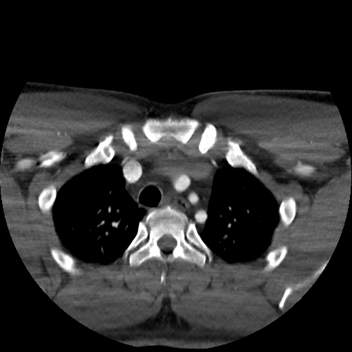 Buccal fat pad arteriovenous malformation (Radiopaedia 70936-81144 A 104).jpg