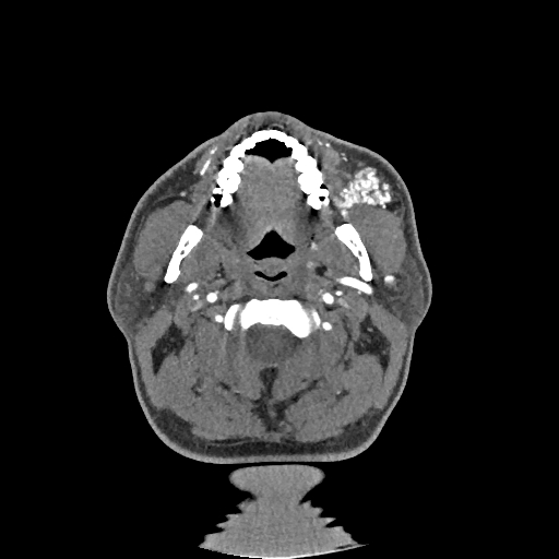 Buccal fat pad arteriovenous malformation (Radiopaedia 70936-81144 D 195).jpg
