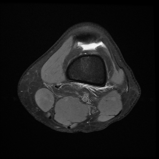 File:Bucket-handle meniscus tear (Radiopaedia 65700-74809 Axial PD fat sat 6).jpg