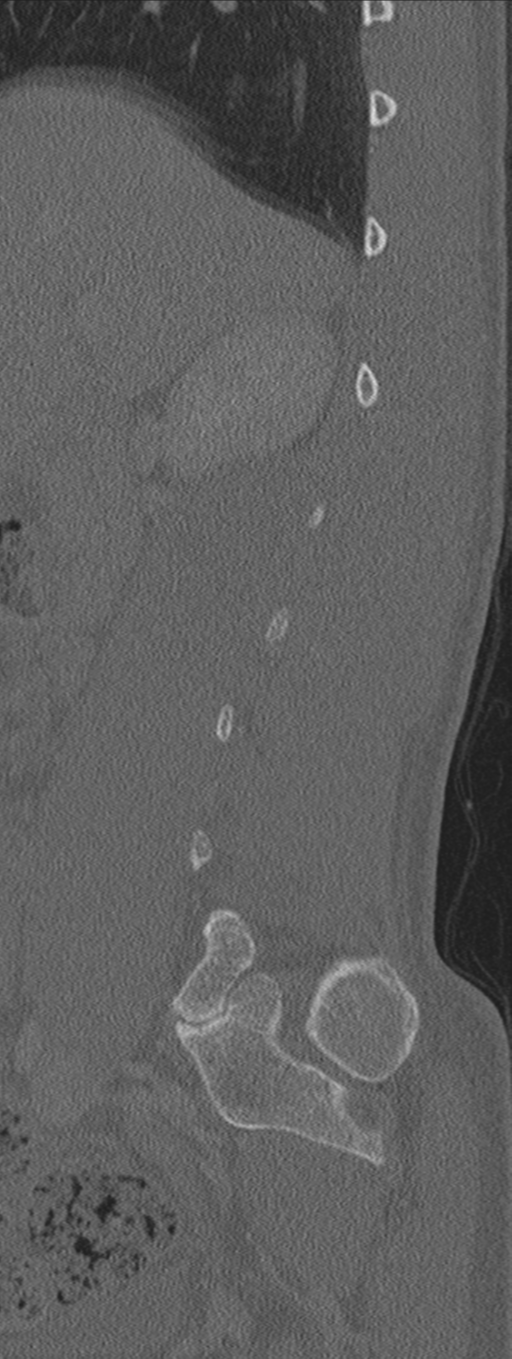 Burst fracture - T12 with conus compression (Radiopaedia 56825-63647 Sagittal bone window 69).png