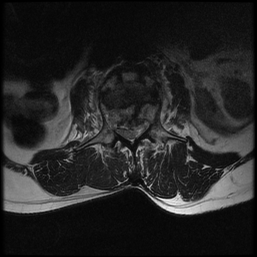 File:Burst fracture - lumbar spine (Radiopaedia 72877-83541 Axial T2 9).jpg