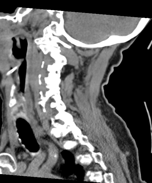 C2 fracture with vertebral artery dissection (Radiopaedia 37378-39199 D 29).png