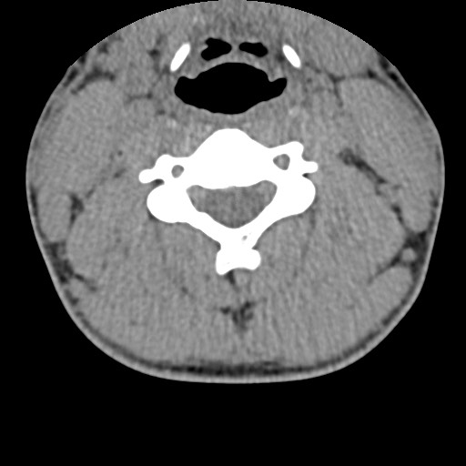 File:C5 facet fracture (Radiopaedia 58374-65499 Axial non-contrast 45).jpg