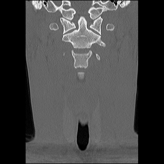 C5 facet fracture (Radiopaedia 58374-65499 Coronal bone window 21).jpg