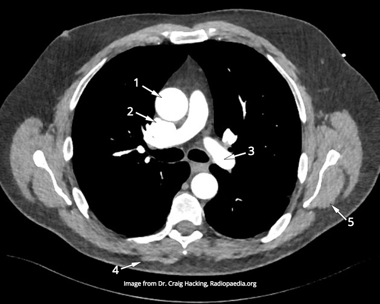 File:CTA thorax (anatomy quiz) (Radiopaedia 60337).jpg