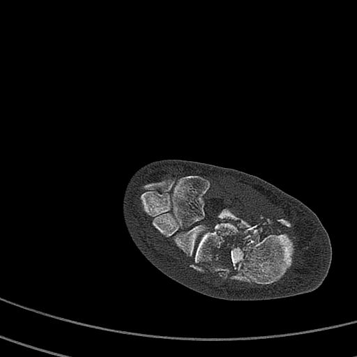 File:Calcaneal fracture - Sanders type 4 (Radiopaedia 90179-107370 Axial bone window 37).jpg