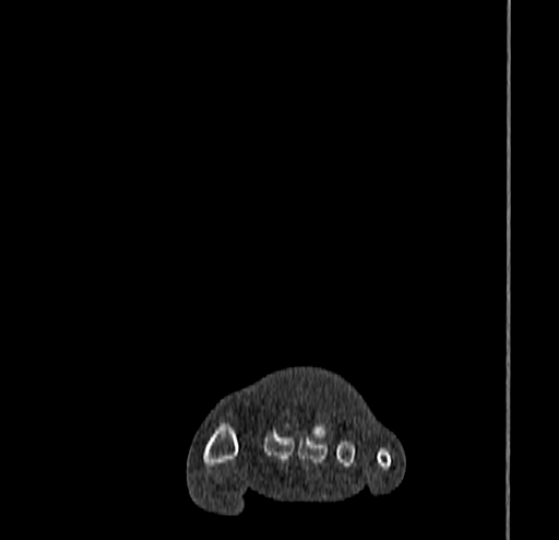 Calcaneal fracture - Sanders type 4 (Radiopaedia 90179-107370 Coronal bone window 18).jpg