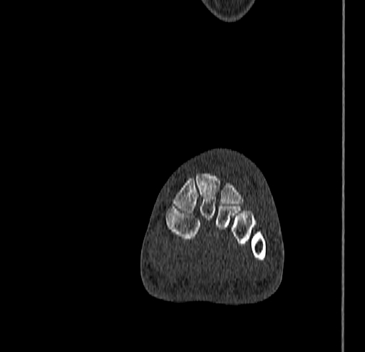 Calcaneal fracture - Sanders type 4 (Radiopaedia 90179-107370 Coronal bone window 41).jpg