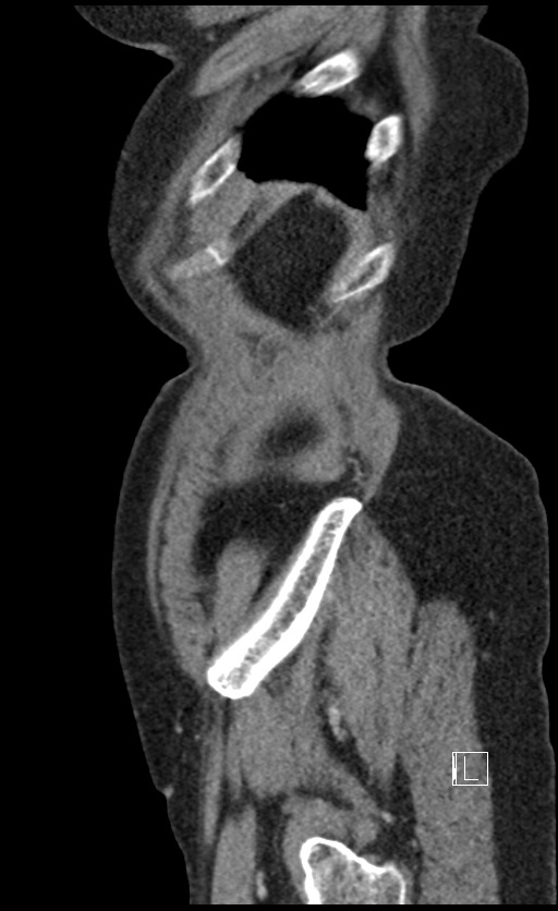 Calcified adrenal glands and Spigelian hernia (Radiopaedia 49741-54988 C 16).jpg