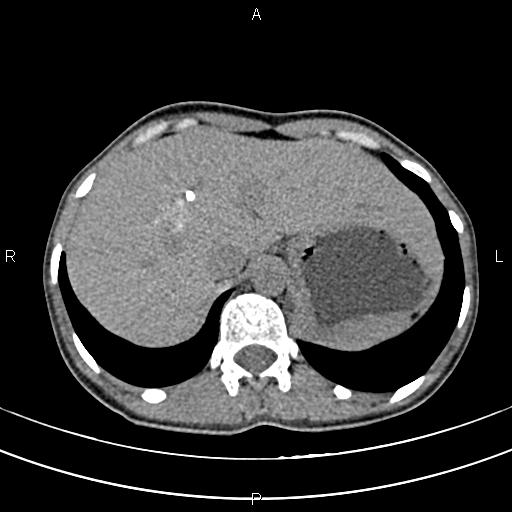 File:Calcified hepatic hydatid cyst (Radiopaedia 83870-99072 Axial non-contrast 32).jpg