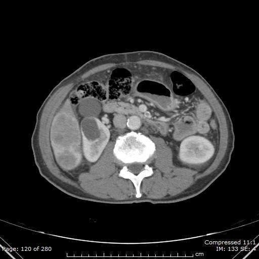 Calcified liver metastases (Radiopaedia 44699-48470 B 43).jpg