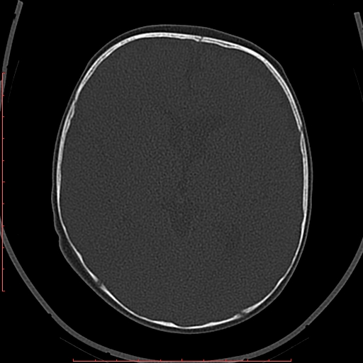 Calcified middle cerebral artery embolism (Radiopaedia 78949-91860 Axial bone window 32).jpg