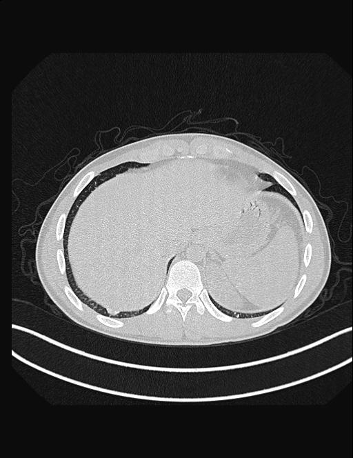 Calcifying pulmonary metastases (Radiopaedia 33359-34396 Axial lung window 55).jpg