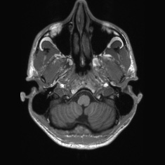 Callosal dysgenesis with interhemispheric cyst (Radiopaedia 53355-59335 Axial T1 20).jpg