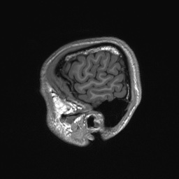 File:Callosal dysgenesis with interhemispheric cyst (Radiopaedia 53355-59335 Sagittal T1 157).jpg