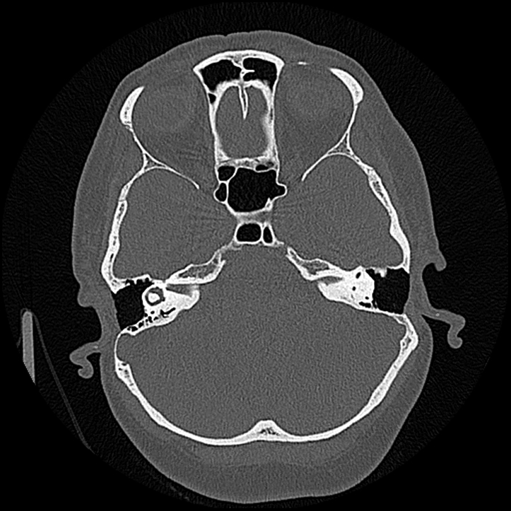 Canal up mastoidectomy (Radiopaedia 78108-90638 Axial bone window 87).jpg