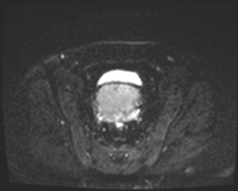 Cancer cervix - stage IIb (Radiopaedia 75411-86615 Axial DWI 17).jpg