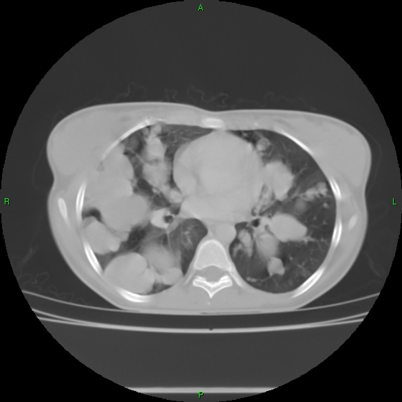 File:Cannon ball metastases - synovial sarcoma (Radiopaedia 26135-26271 Axial lung window 20).jpg