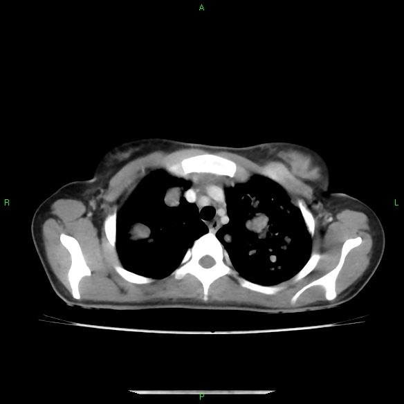 File:Cannon ball metastases - synovial sarcoma (Radiopaedia 26135-26271 C 8).jpg