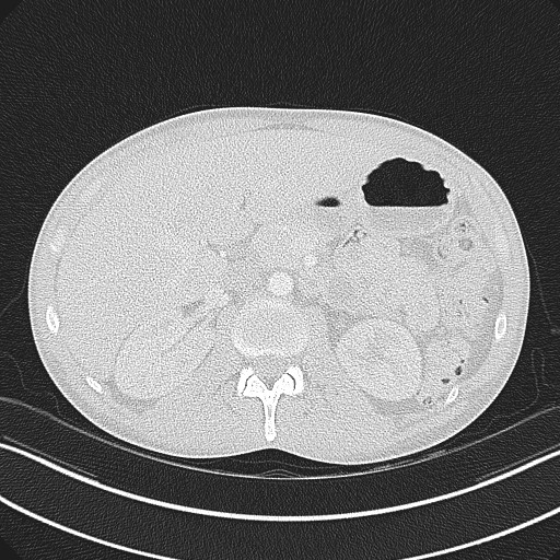 Cannonball metastases - testicular choriocarcinoma (Radiopaedia 84510-99891 Axial lung window 106).jpg