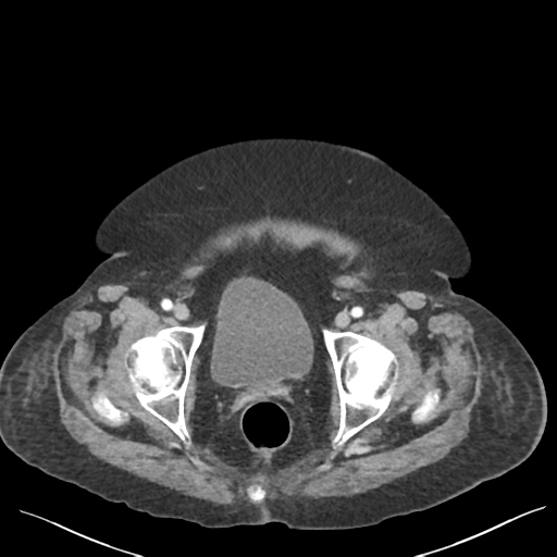 Cannonball metastases from endometrial cancer (Radiopaedia 42003-45031 E 71).png