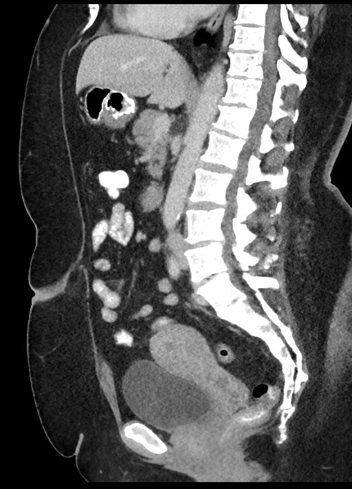 Carcinoid tumor - terminal ileum (Radiopaedia 60931-68739 C 47).jpg