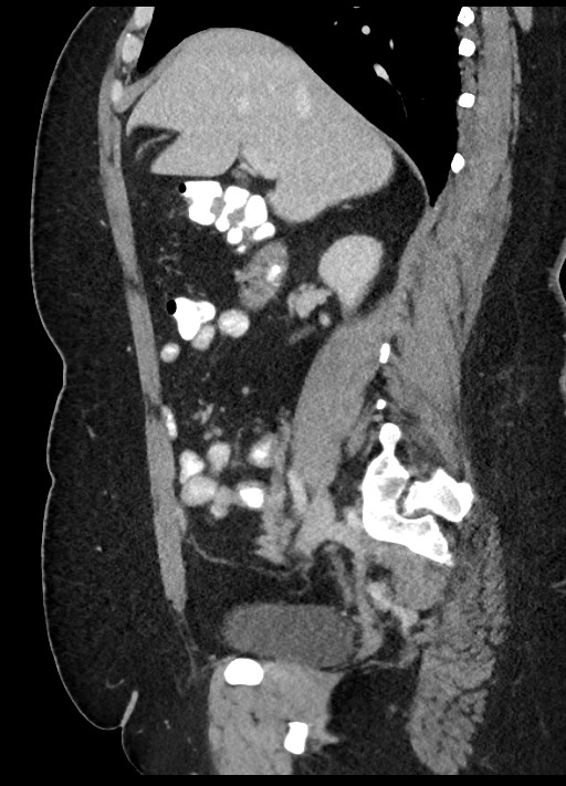 Carcinoid tumor - terminal ileum (Radiopaedia 60931-68739 C 63).jpg