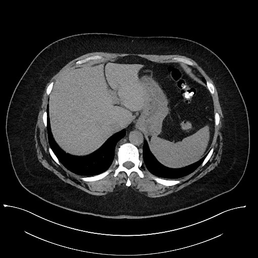 Carcinoid tumor - terminal ileum (Radiopaedia 60931-68740 Axial non-contrast 12).jpg