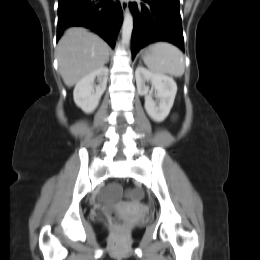 File:Carcinoma colon - hepatic flexure (Radiopaedia 19461-19493 B 27).jpg