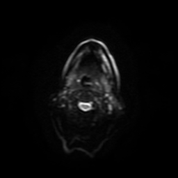 Carcinoma ex-pleomorphic adenoma of parotid (Radiopaedia 28383-28627 Ax DWI B-500 GE 9).jpg